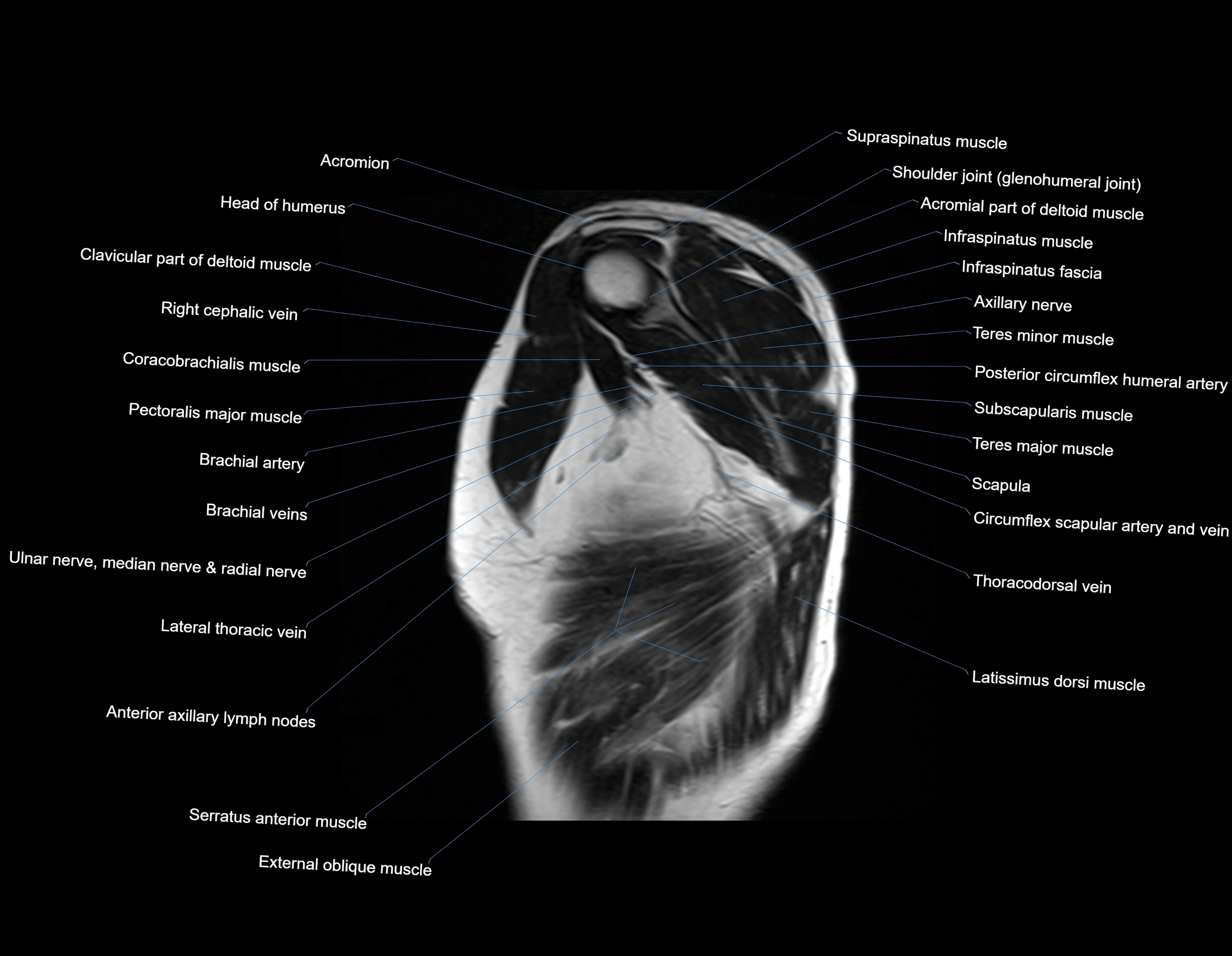 MRI chest (thorax) sagittal labelled cross sectional anatomy 3T radiology image-img-00001-00003.webp